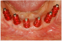 下の歯茎に6本のインプラント　歯を被せる前の写真